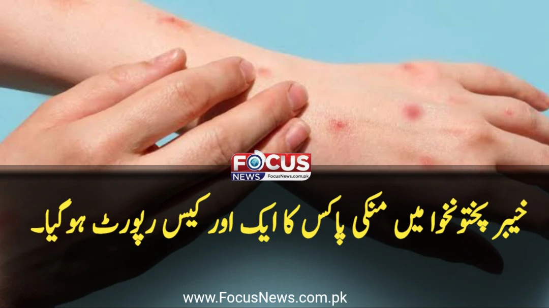 خیبر پختونخوا میں منکی پاکس کا ایک اور کیس رپورٹ ہوگیا۔